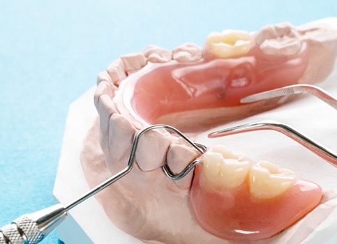 partial dentures on a model of a mouth