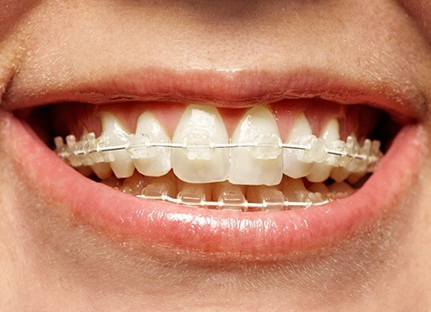 Patient with six month smiles ceramic braces