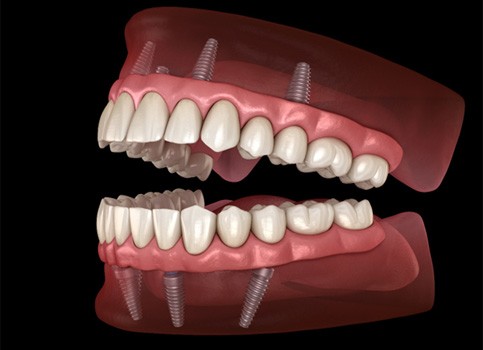 illustration of how implant dentures work 