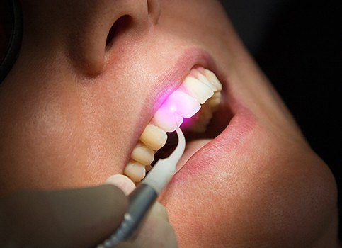 Patient receiving soft tissue laser dentistry