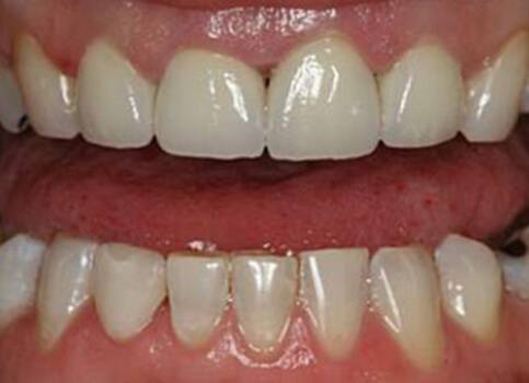 Healthy smile after dental restoration and cosmetic dentistry