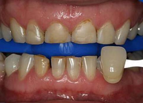 Smile with severe decay on upper and lower teeth