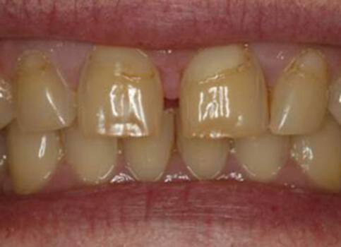 Severely discolored teeth