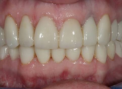 Brilliant smile after teeth whitening