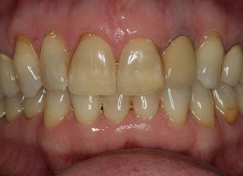 Yellow smile before teeth whitening