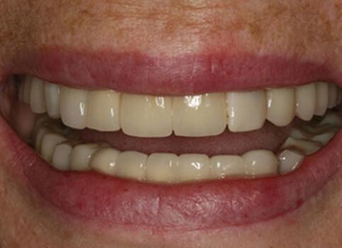 Smile with natural looking and seamless partial denture