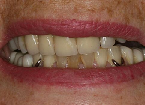 Smile with discolored and worn partial denture