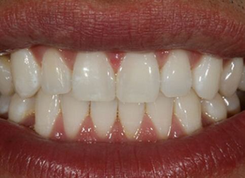 Gap between teeth closed after cosmetic dentistry