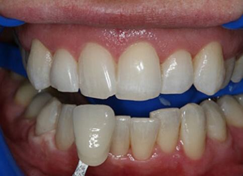 Brilliant smile after teeth whitening