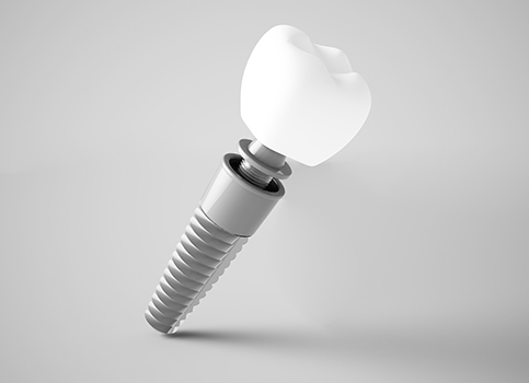 Animated dental implant supported dental crown