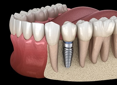 Animated dental implant supported dental crown placement