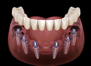 Animated dental implant supported denture