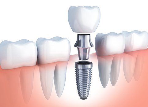 Animated parts of a dental implant replacement tooth