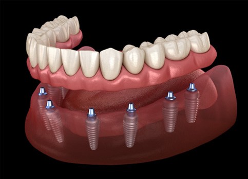 A 3D illustration of implant dentures