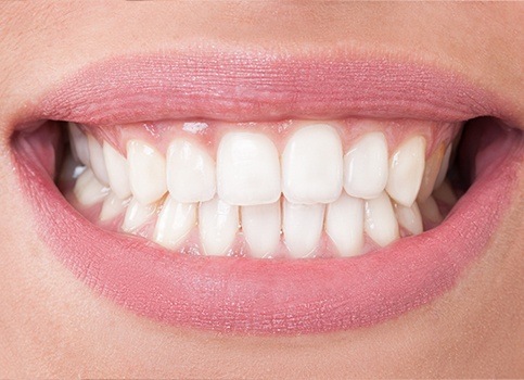 Closeup of smile after scaling and root planing periodontal therapy