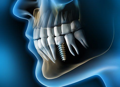 Animated dental implant supported dental crown