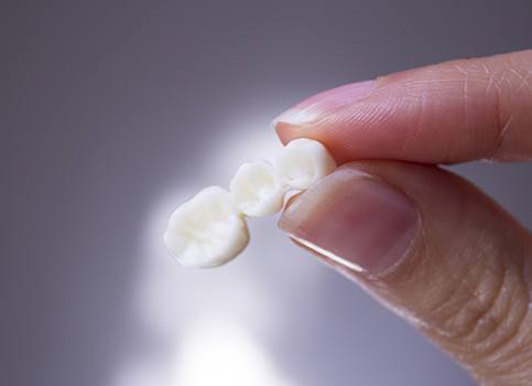 Hand holding a dental crown supported fixed bridge restoration prior to placement