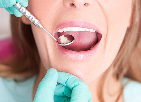 Dentist checking woman's tooth colored filling