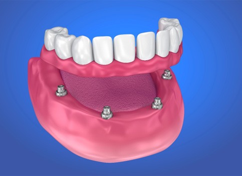 denture being placed onto four dental implants in the lower arch  