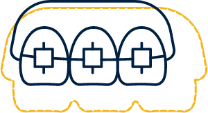 Animated row of teeth with braces