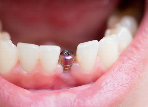A mouth housing a single tooth implant in Sunnyside.