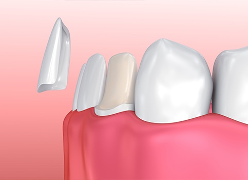 Amimated porcelain veneer placement process