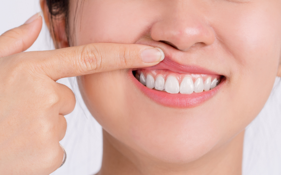 Woman showing gums