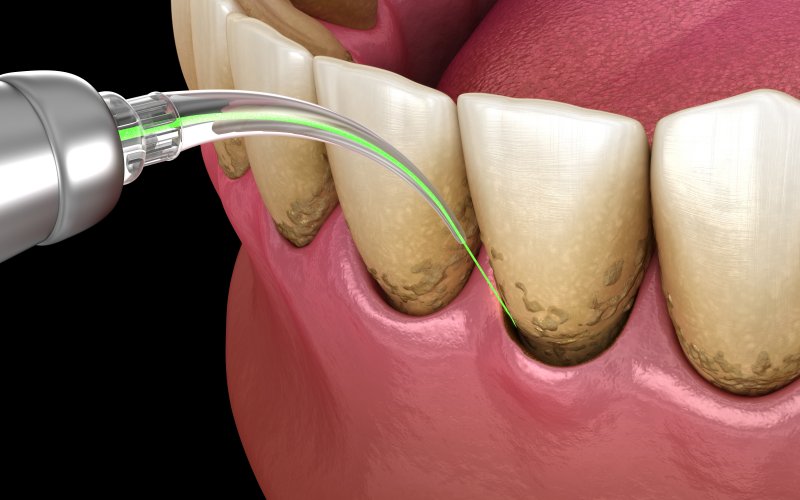 digital image of a dental laser treating gum disease